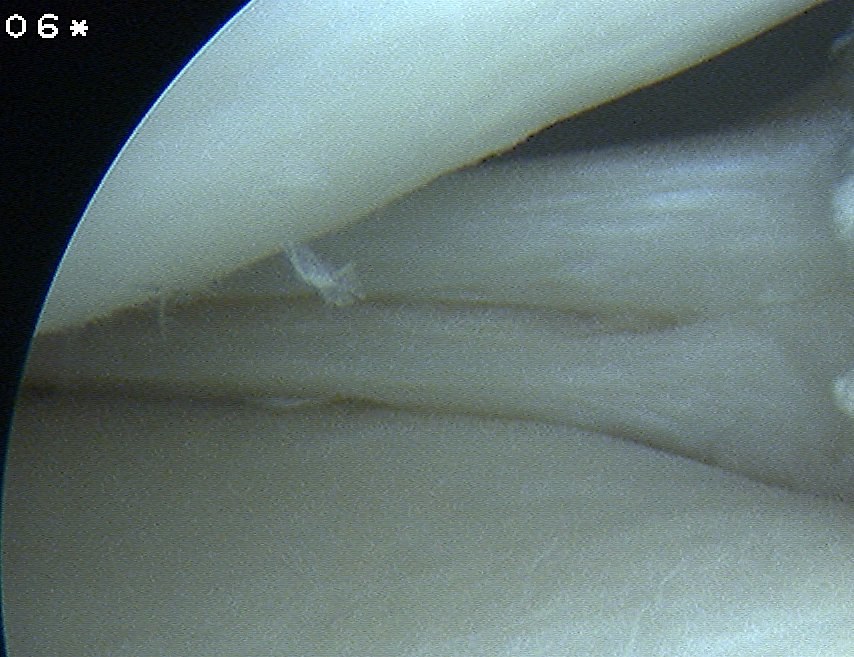 Meniscus Horizontal Tear